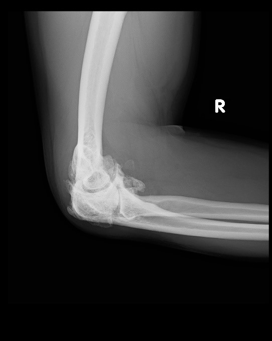 Elbow Arthritis Symptoms, Causes, and Treatments in Abu Dhabi