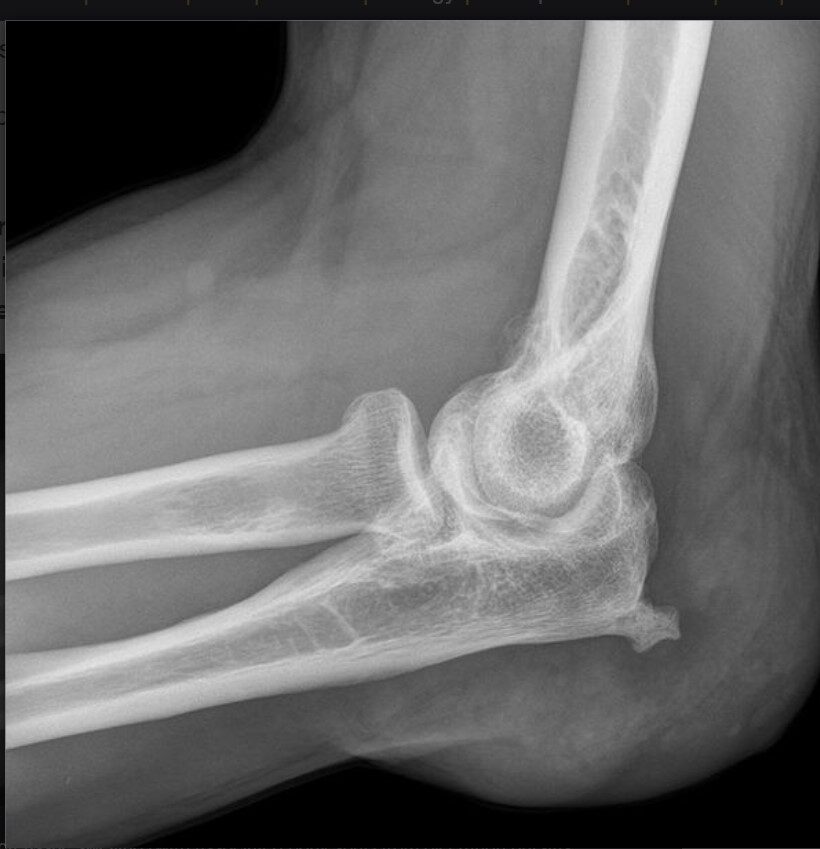 Elbow (Olecranon) Bursitis treatment in Abu Dhabi UAE