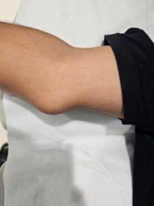elbow-pic-10
