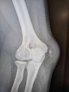 elbow-pic-11