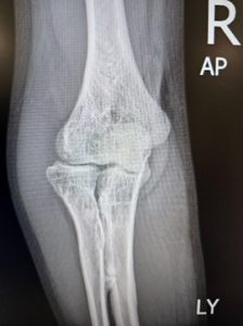 elbow-pic-7