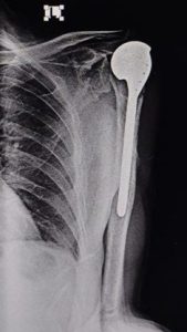 shoulder-2