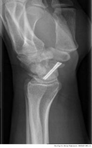 wrist-and-hand-1-65