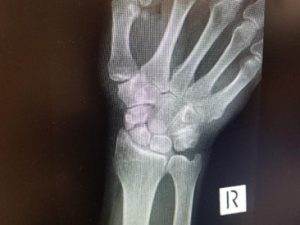 wrist-and-hand-1-68