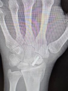 wrist-and-hand-1-71